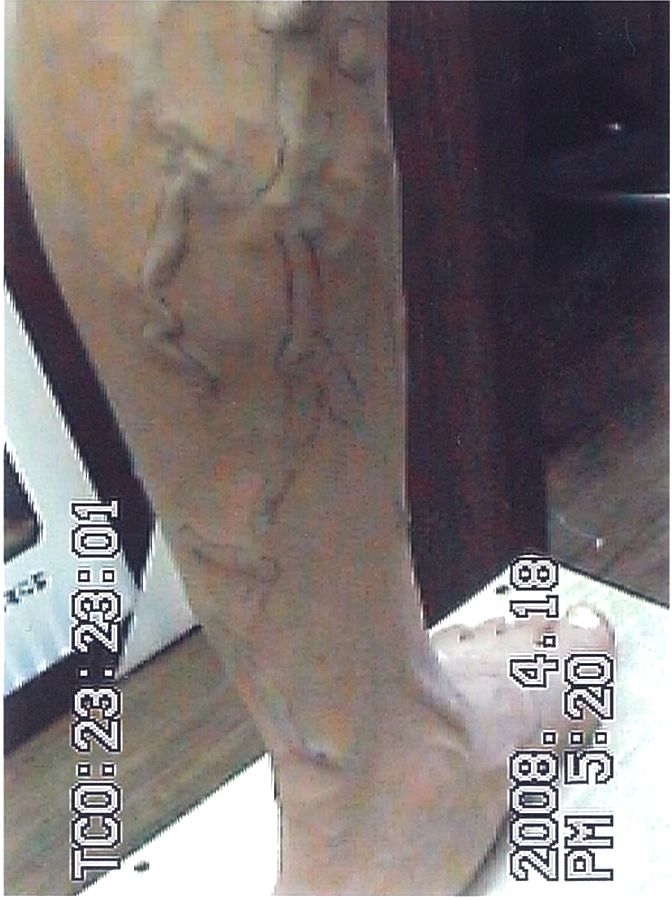 하지정맥