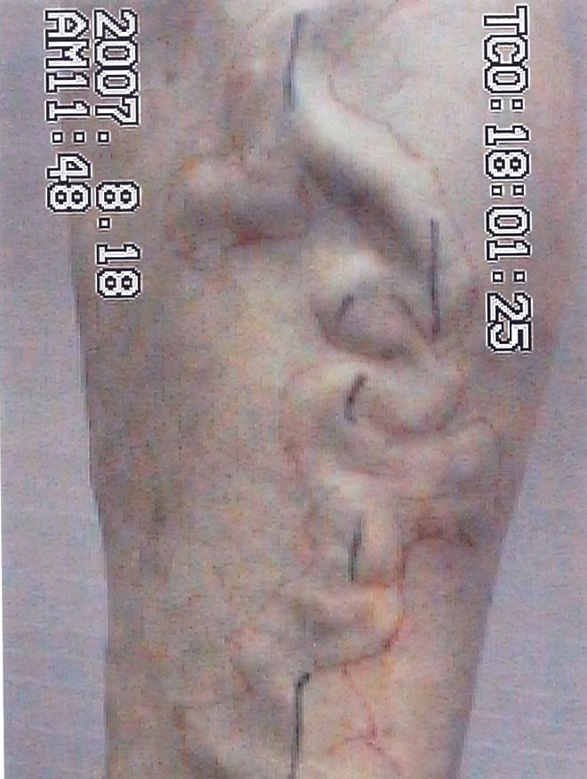 하지정맥