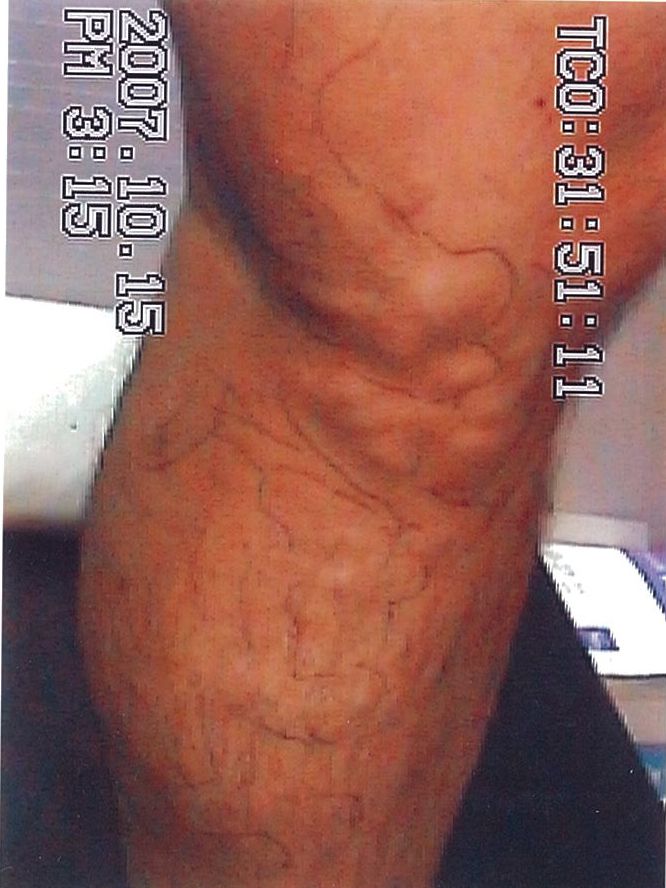 하지정맥