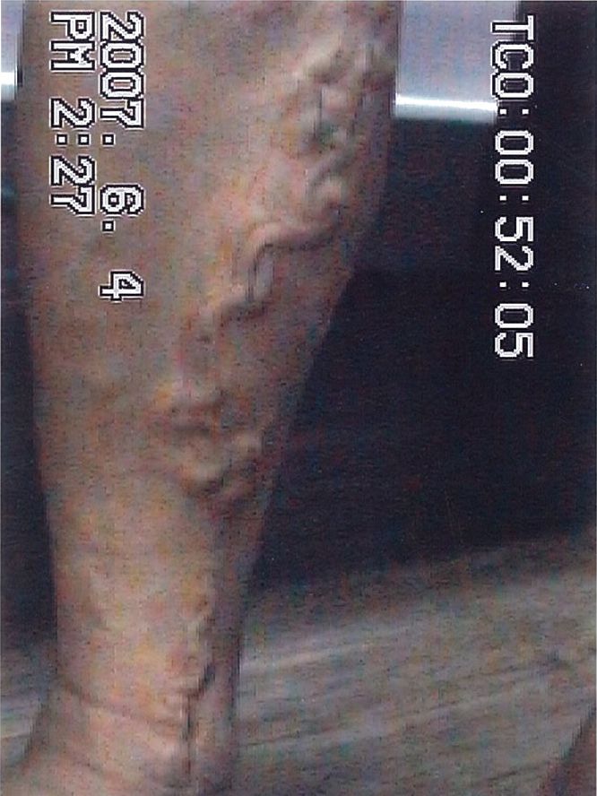 하지정맥